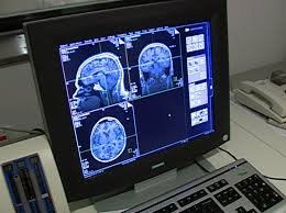 temp_image_1762655401.701562 Alerta Global da OMS: A Crise Silenciosa das Doenças Neurológicas e o Desafio do Brasil